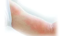Occupational skin diseases 