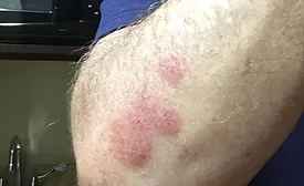Bed bug bites