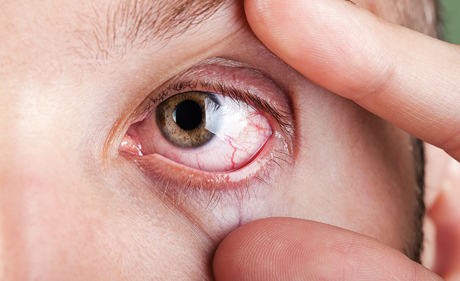 Eye protection against irritants