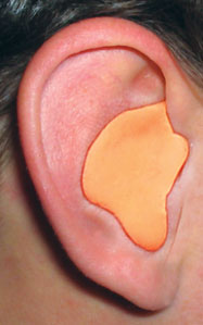 Custom-molded earplugs