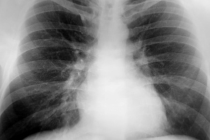 lungs-xray-422.jpg