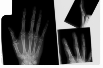 hand-injury-2-422.jpg